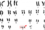 Trisomia 21