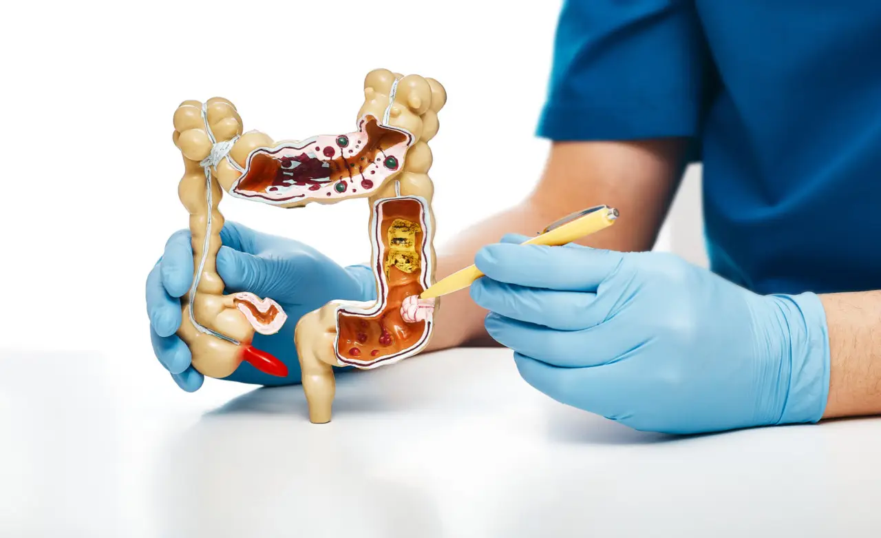 Vivere senz’intestino: ecco cosa succede dopo un intervento così drasticamente invalidante
