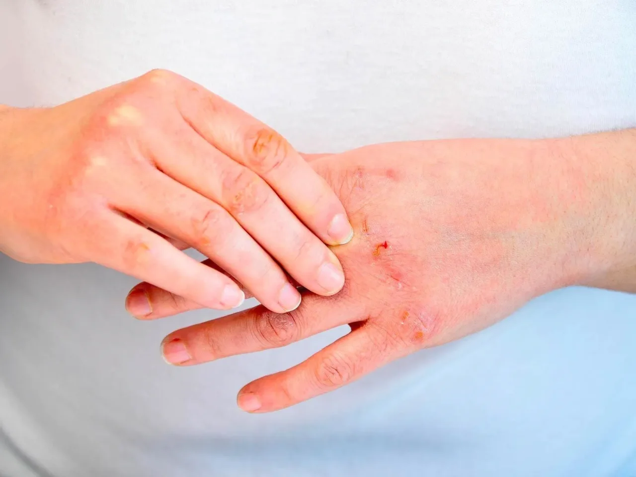 Dermatite o eruzioni cutanee durante la dentizione? Ecco come alleviare subito il fastidio