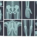 Soffri di osteoporosi grave? Ecco quando hai diritto all’invalidità e come richiederla