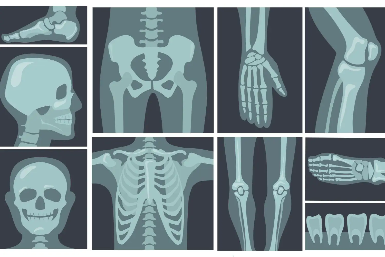 Soffri di osteoporosi grave? Ecco quando hai diritto all’invalidità e come richiederla