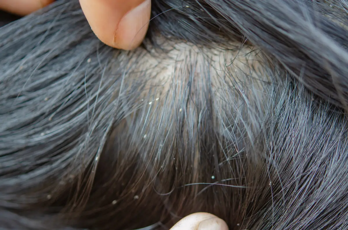 Hai la pelle squamosa e rossa? Potrebbe essere questa forma particolare di psoriasi