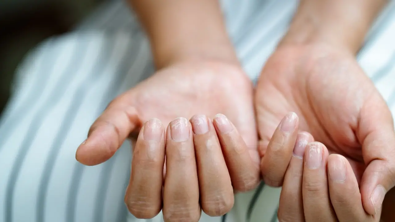 Quali sono i sintomi di una carenza di zinco? Pelle, capelli e unghie deboli
